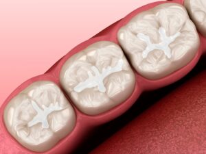 Dental Sealants: Are They Worth It for Adults Too?
