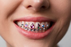 tooth gems for adults what you should know