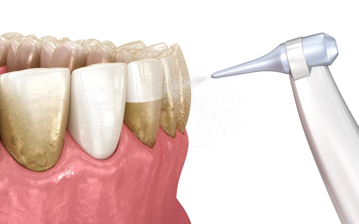 air polishing vs teeth cleaning
