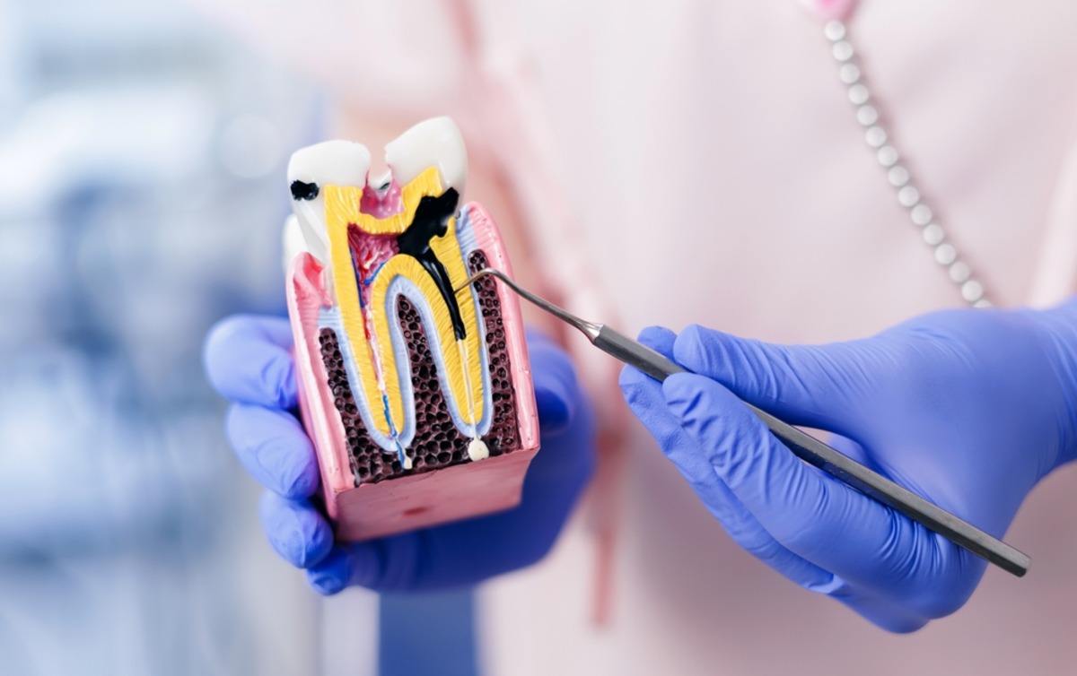 drill free cavity treatment